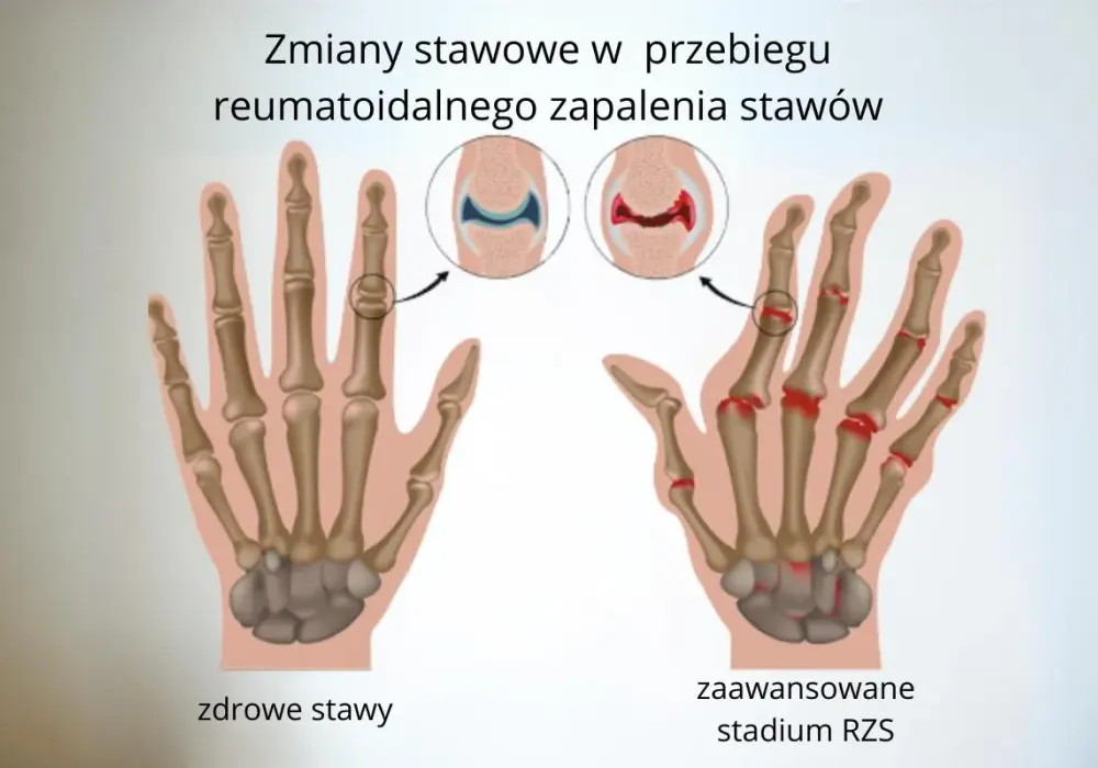 Reumatoidalne zapalenie stawów u dzieci objawy, które mogą zaskoczyć rodziców