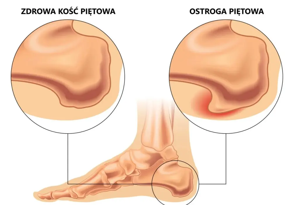 Ostroga piętowa - Babcine sposoby, które naprawdę działają