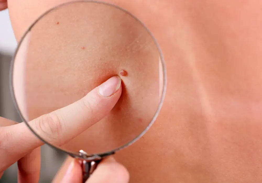 Rozdrapany pieprzyk - jak postępować i kiedy iść do dermatologa?