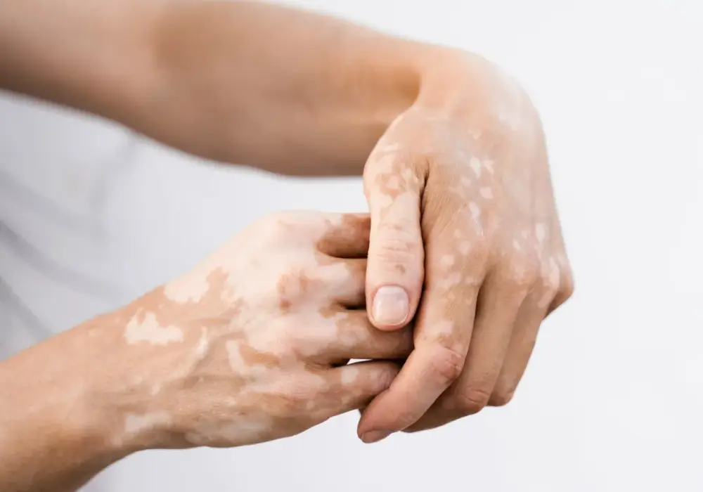 Białe plamki na skórze - co oznaczają i kiedy iść do dermatologa?