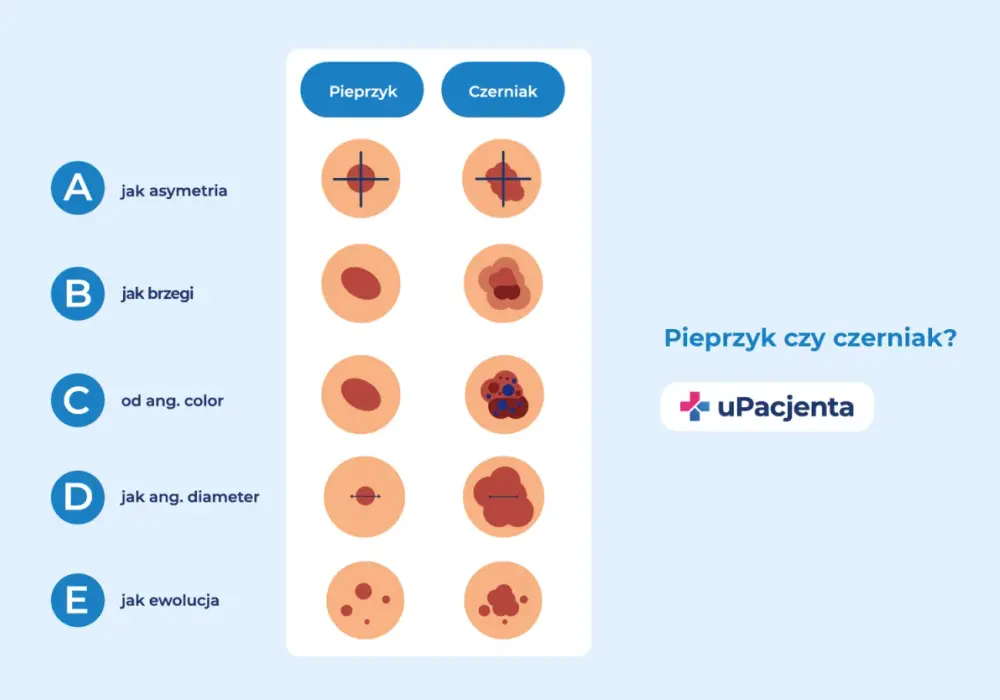 Czerniak czy pieprzyk? Jak odróżnić i kiedy do lekarza?