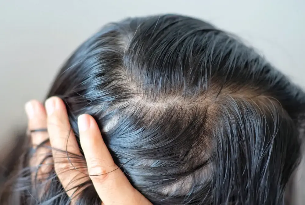 Świąd skóry głowy - co go powoduje i kiedy iść do dermatologa?