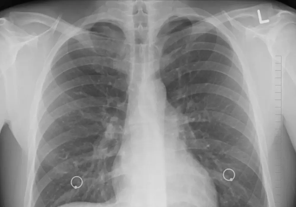 Rozedma płuc - Czy to tylko zadyszka? Objawy, leczenie, diagnostyka