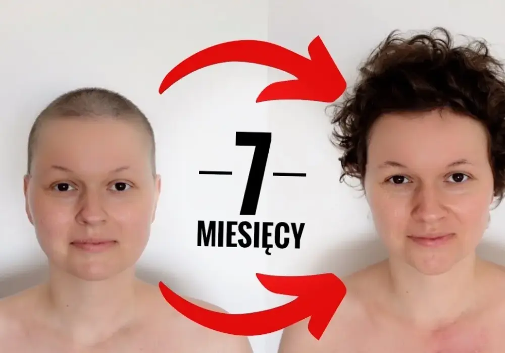 Jak szybko odrastają włosy po chemii? Poznaj kluczowe czynniki