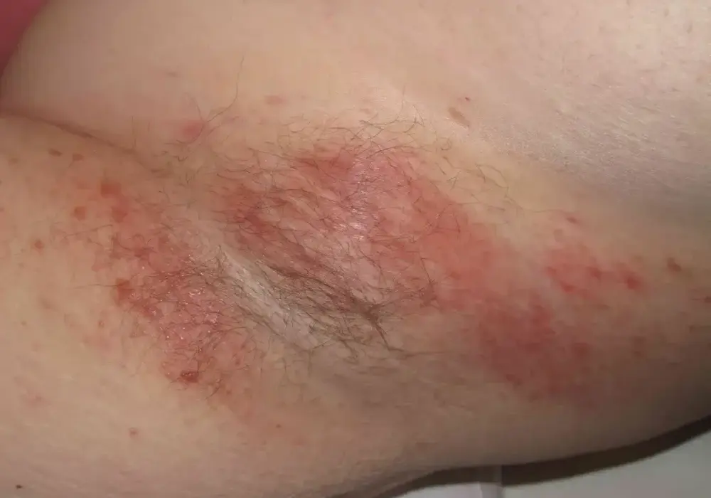 Odparzenia pod pachami - Skąd się biorą i jak je leczyć?