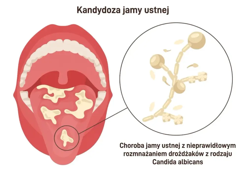 Kandydoza jamy ustnej - objawy, leczenie i nawroty