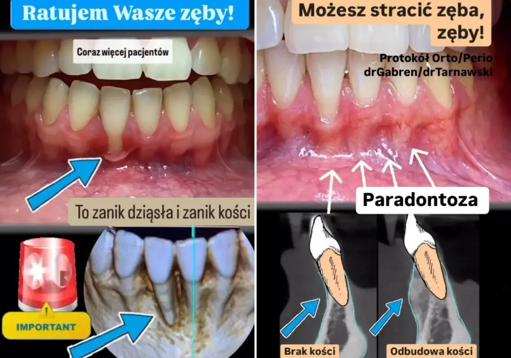 Recesja dziąseł przed i po - czy zawsze widać sukces?
