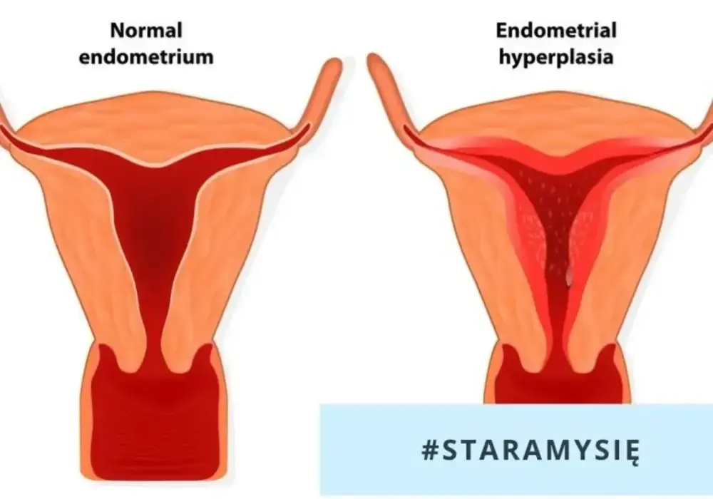 Biopsja endometrium - Co musisz wiedzieć o zabiegu i wyniku?