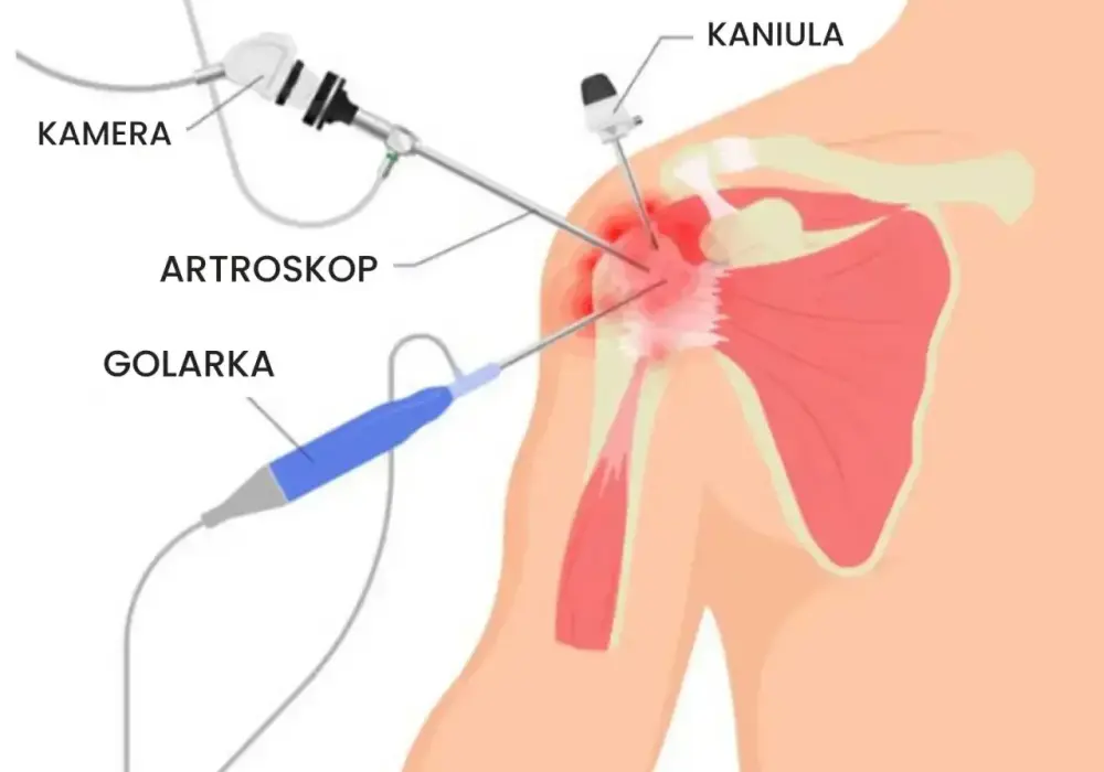 Artroskopia barku NFZ gdzie najszybciej? Sprawdź najlepsze miejsca