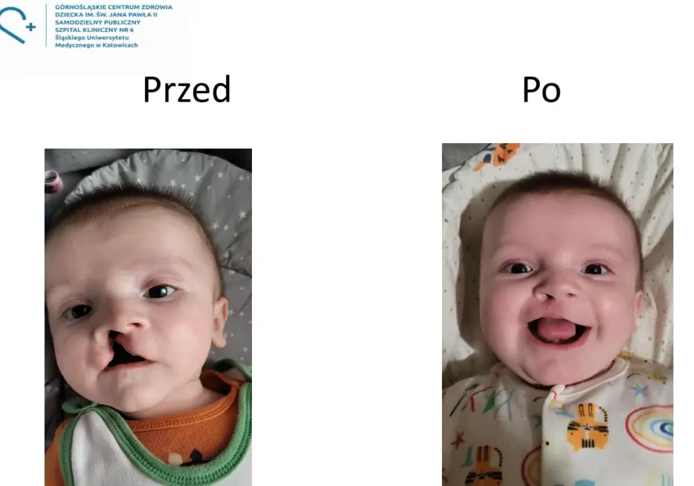 Rozszczep podniebienia - co musisz wiedzieć o leczeniu i objawach?