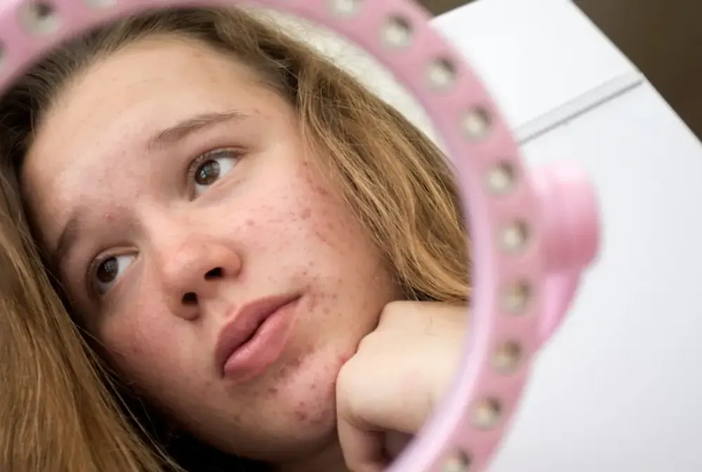Trądzik u nastolatków - jak ułożyć rutynę i kiedy do dermatologa