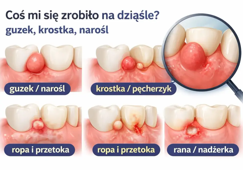 Dziura przy dziąśle - Co oznacza i jak leczyć?