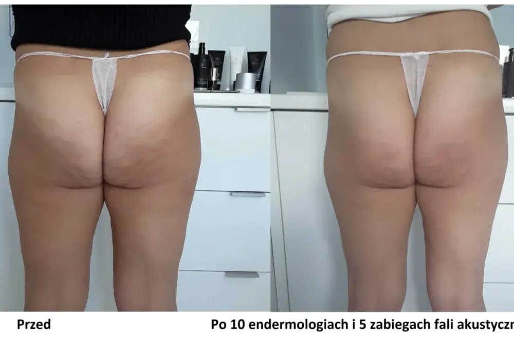 Skuteczne metody na cellulit - jak leczyć cellulit w domu i w gabinecie