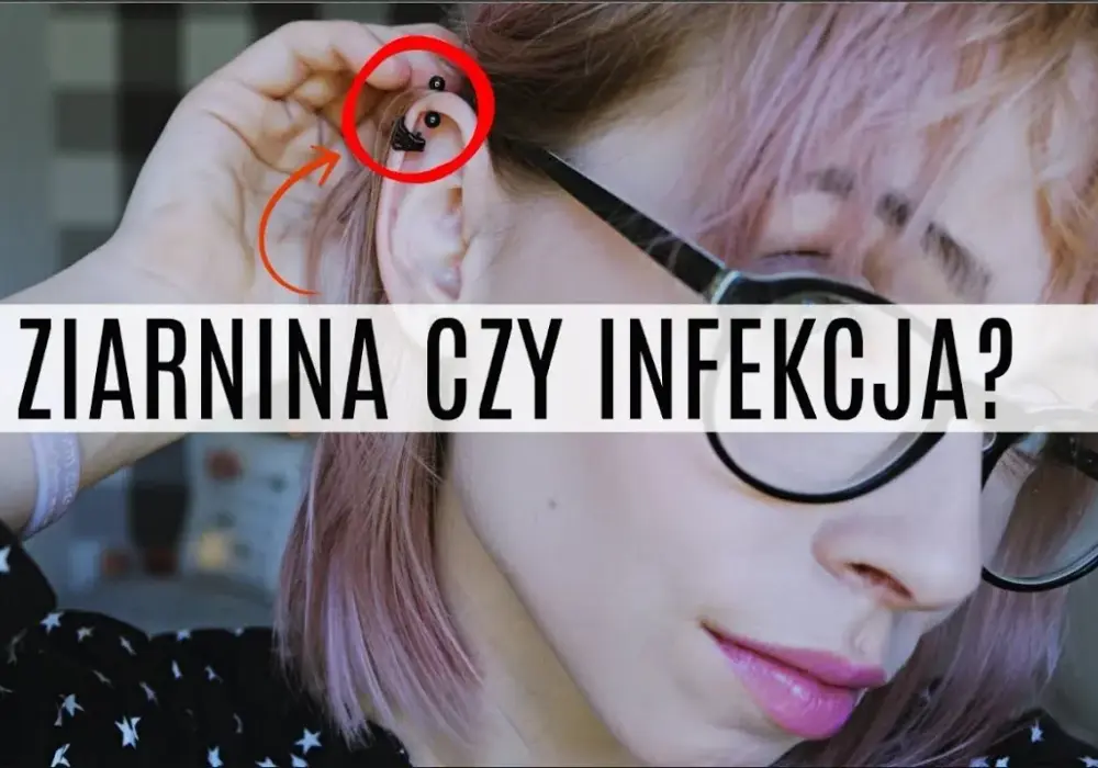Jak skutecznie leczyć ziarninę po piercingu i uniknąć powikłań