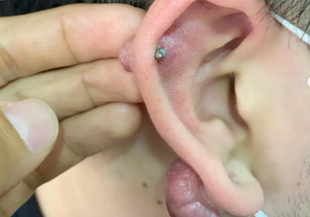 Zgrubienie po przekłuciu - Keloid czy infekcja? Co robić?