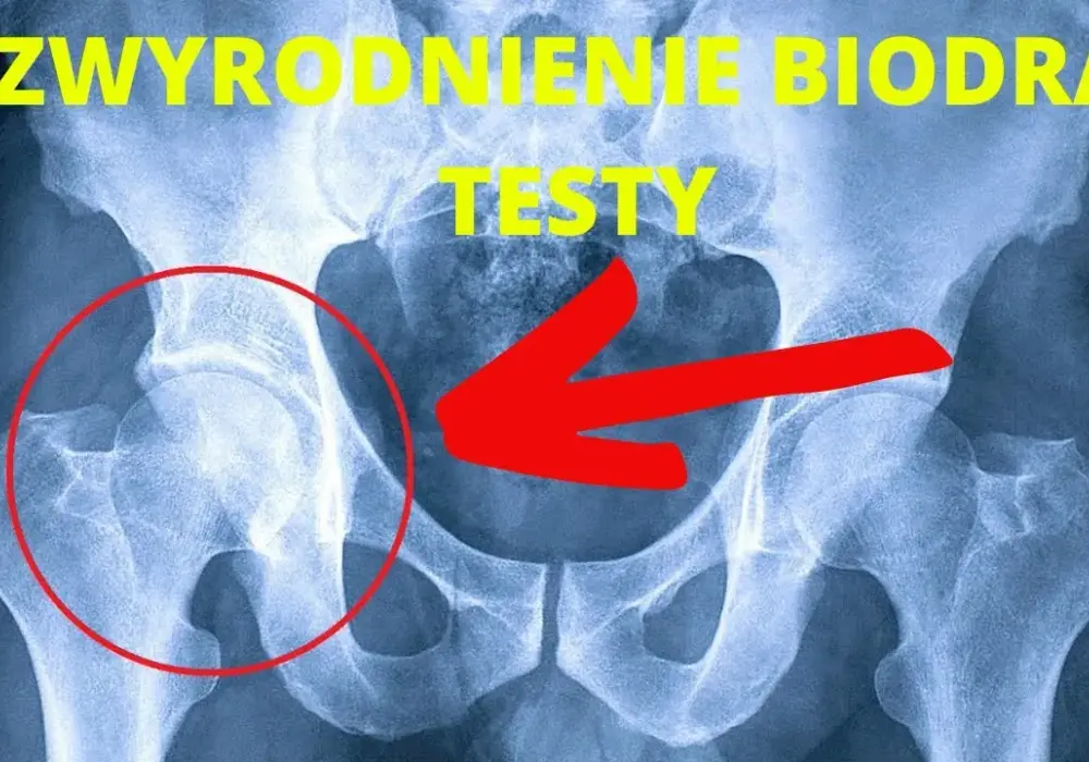 Odkryj tajniki Totalna Biologia Biodro i zwalczyj ból biodra efektywnie