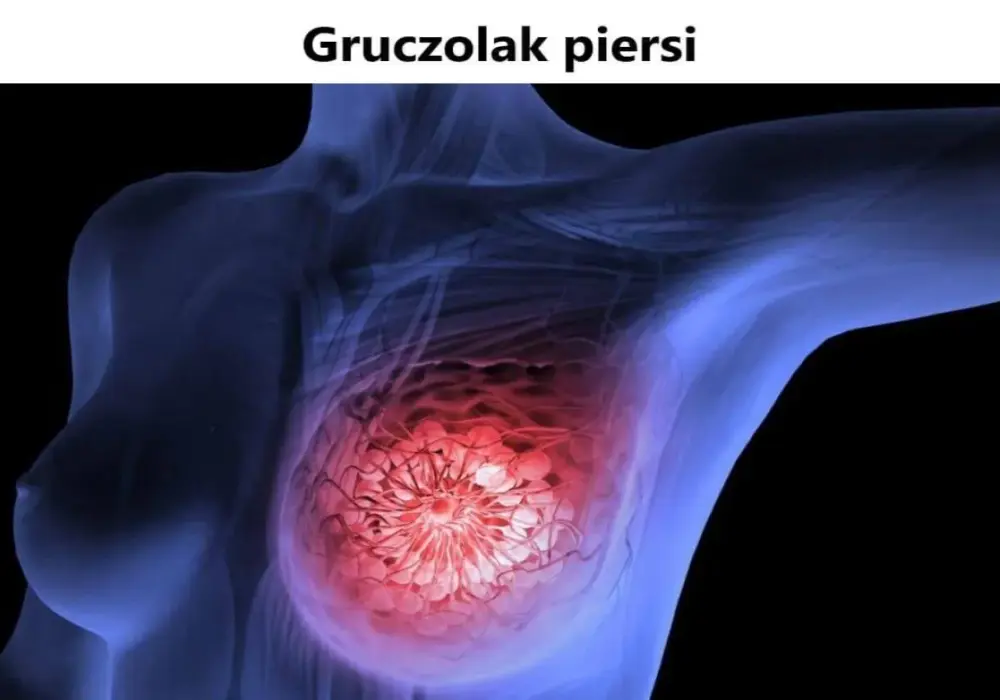 Gruczolak - łagodny guz, ale czy zawsze bezpieczny?