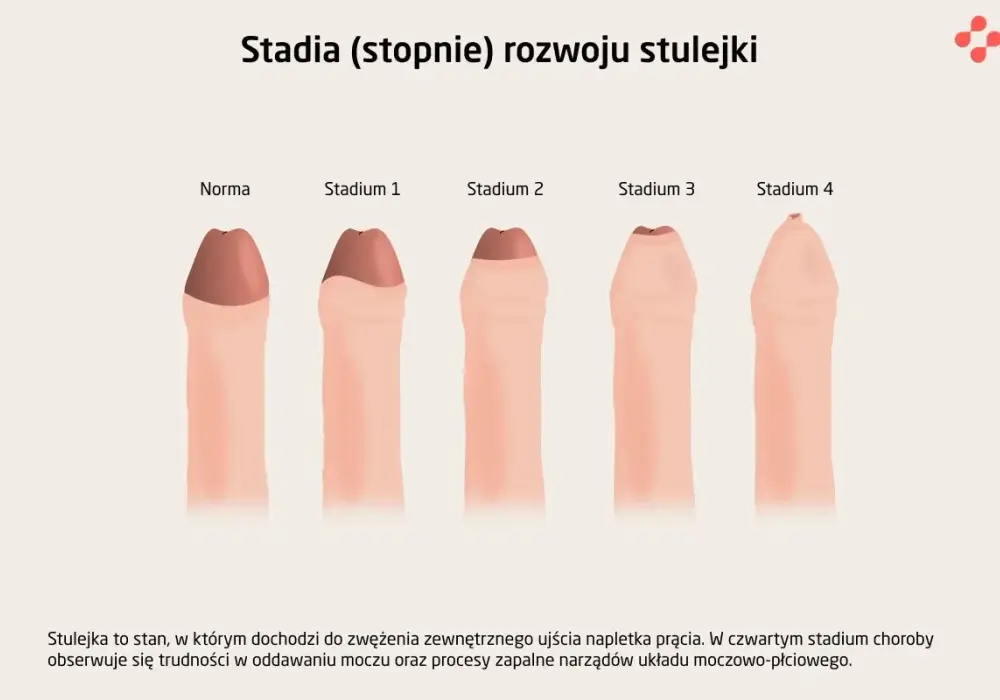 Stulejka - kiedy to norma, a kiedy wymaga leczenia?