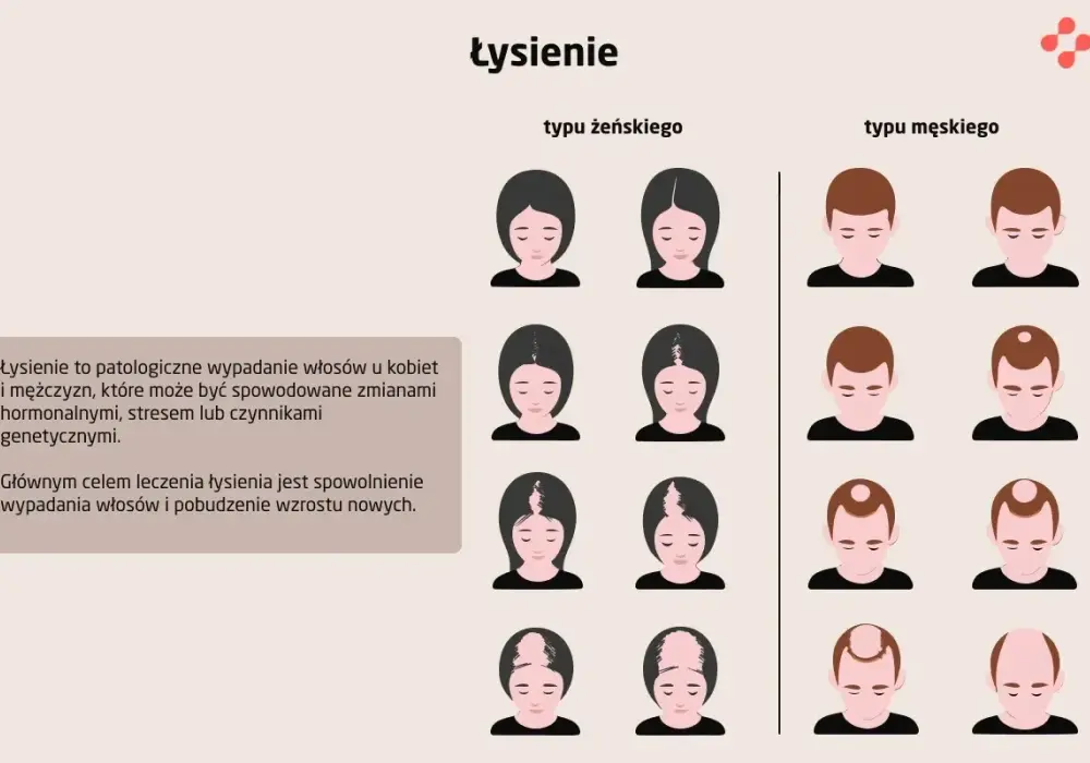 Łysienie plackowate - odrost włosów? Jak ocenić postęp
