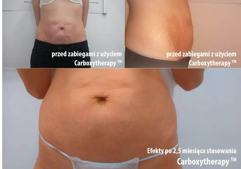 Karboksyterapia efekty - Realna poprawa skóry czy marketingowy chwyt?
