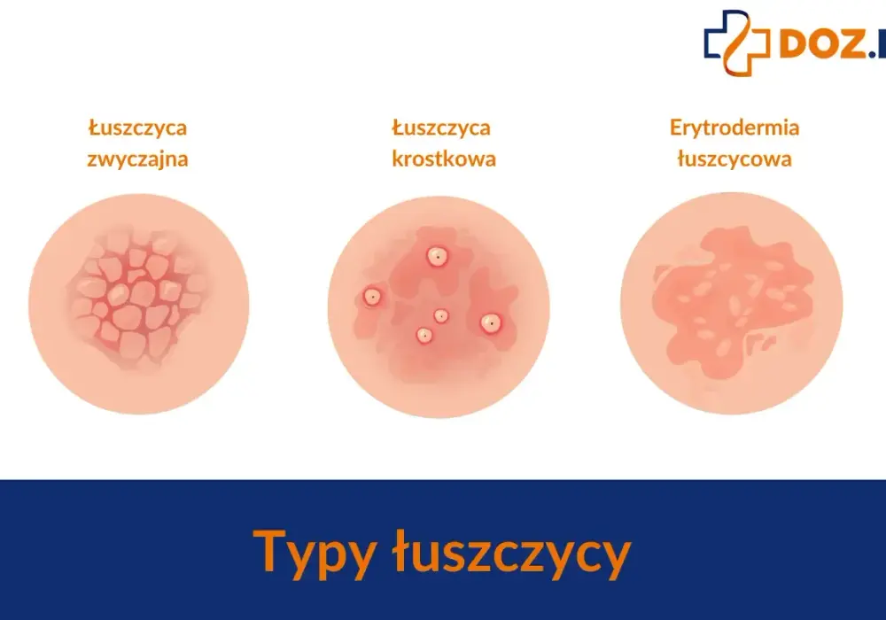 Łuszczyca - pierwsze objawy? Rozpoznaj i pielęgnuj skórę!
