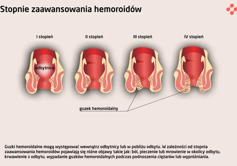 Objawy hemoroidów - Kiedy to coś więcej niż hemoroidy?