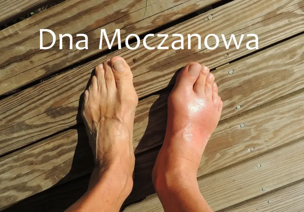 Objawy dny moczanowej - Czy to na pewno dna? Sprawdź!