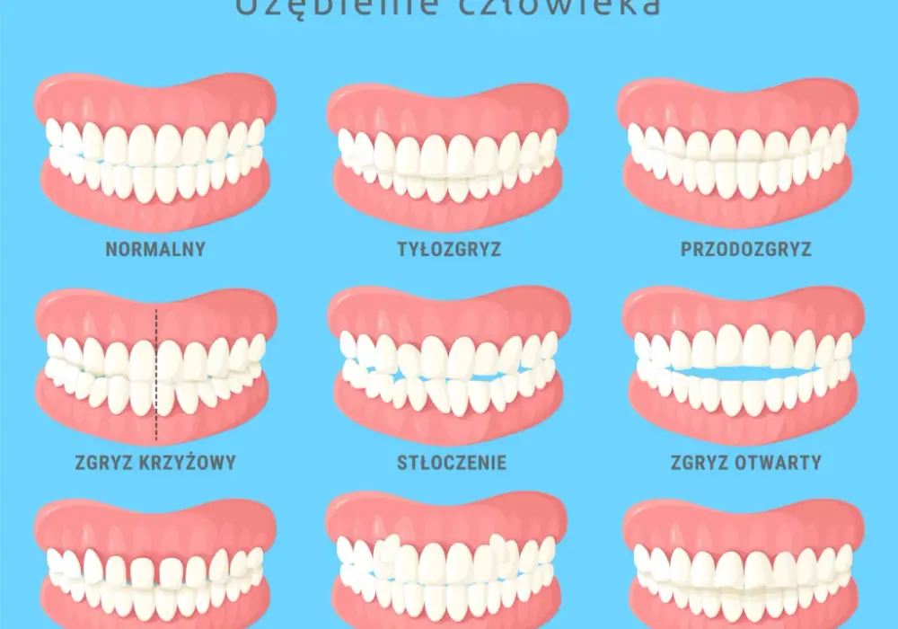 Czy aparat ortodontyczny jest na NFZ? Sprawdź, kto może skorzystać