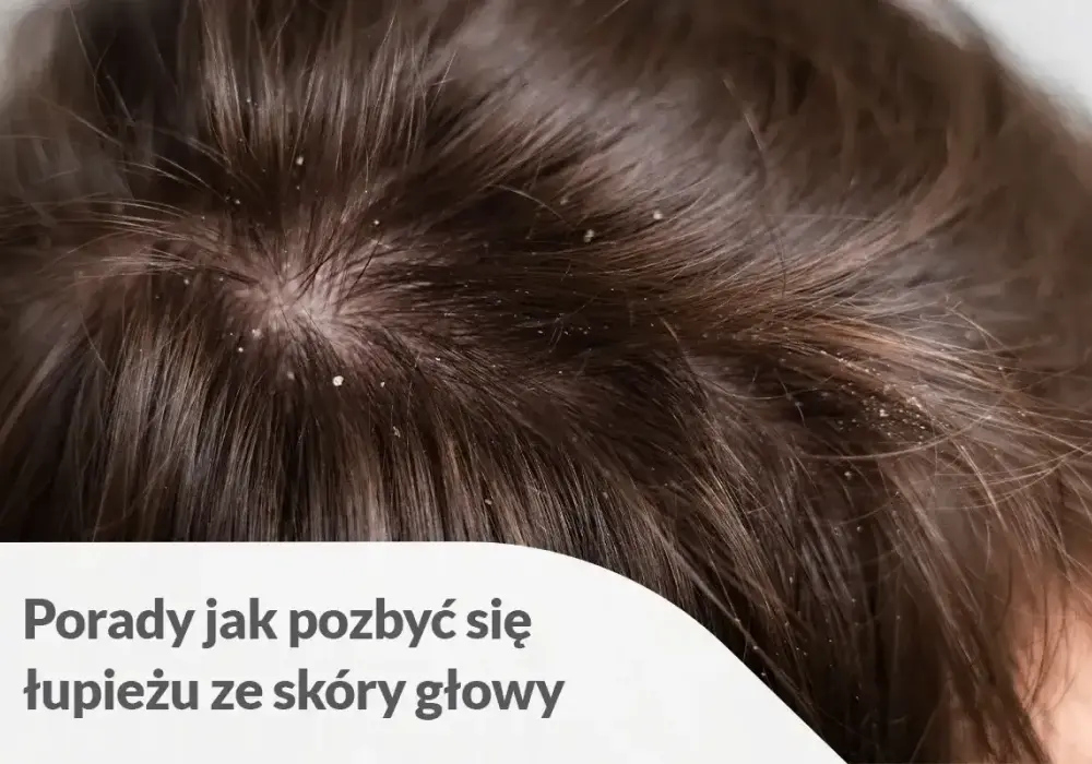 Cyklopiroks - Twój lek na łupież? Kiedy działa, jak stosować?