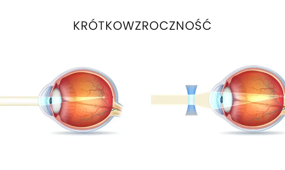 Czy wadę wzroku minusy można wyleczyć? Prawda o krótkowzroczności