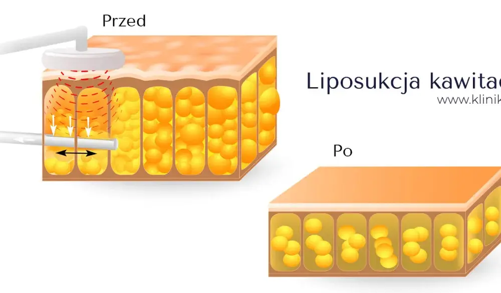 Liposukcja kawitacyjna - jak działa i kiedy ma sens?