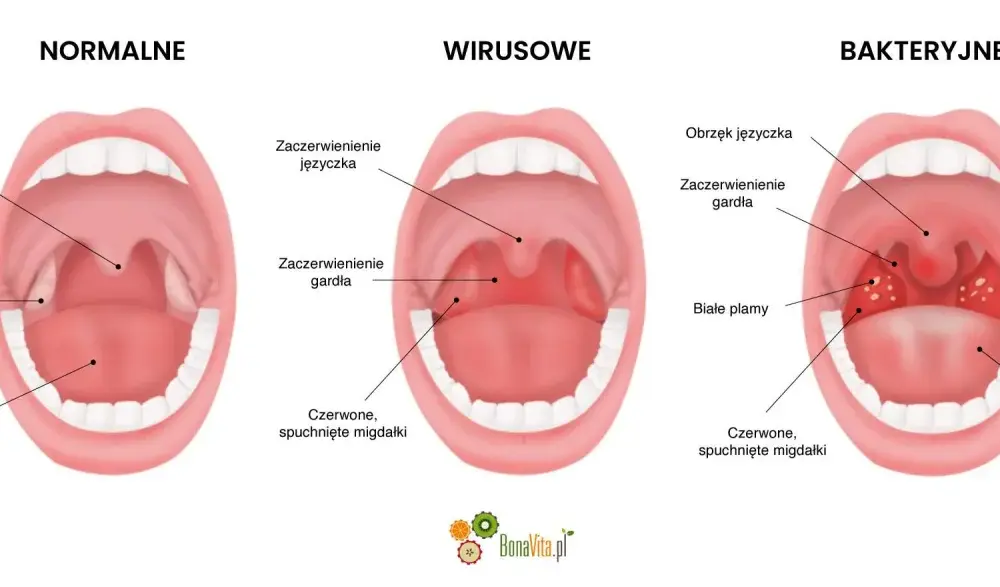 Angina bakteryjna - Czy zawsze potrzebny antybiotyk?