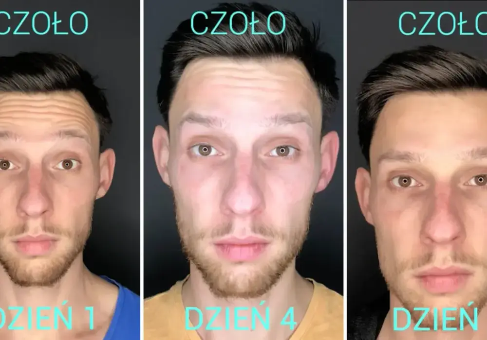 Botoks kiedy efekt - jak szybko zobaczysz rezultaty i co warto wiedzieć