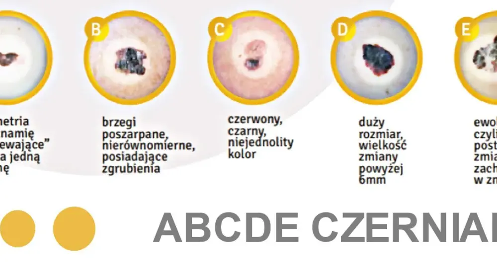 Czerniak - Jak rozpoznać niepokojące znamię? Reguła ABCDE