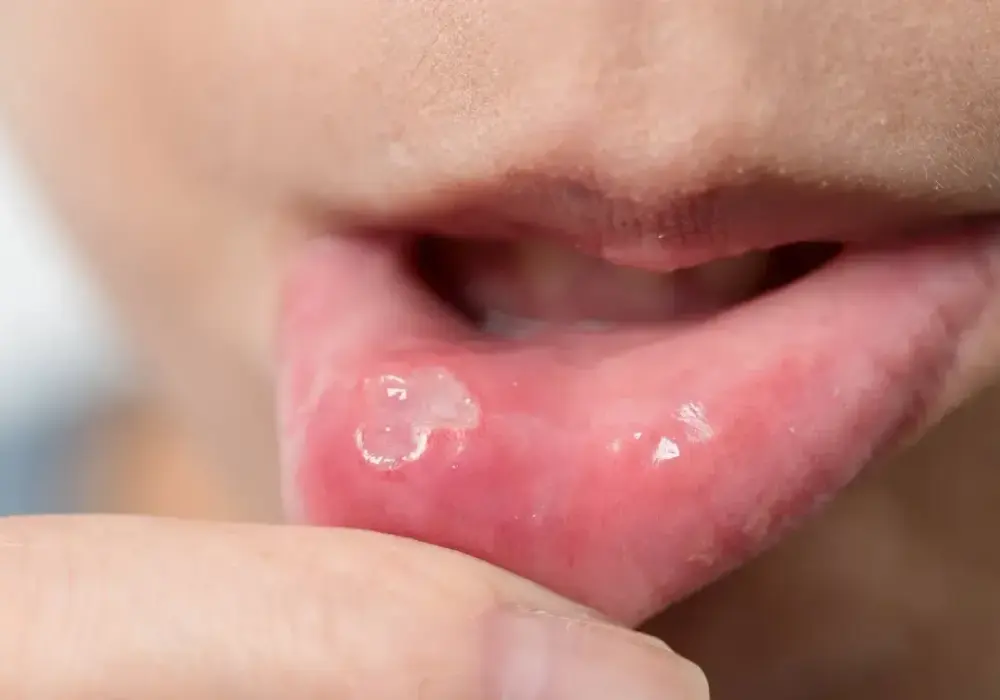 Torbiel śluzowa w jamie ustnej - kiedy trzeba iść do dentysty?