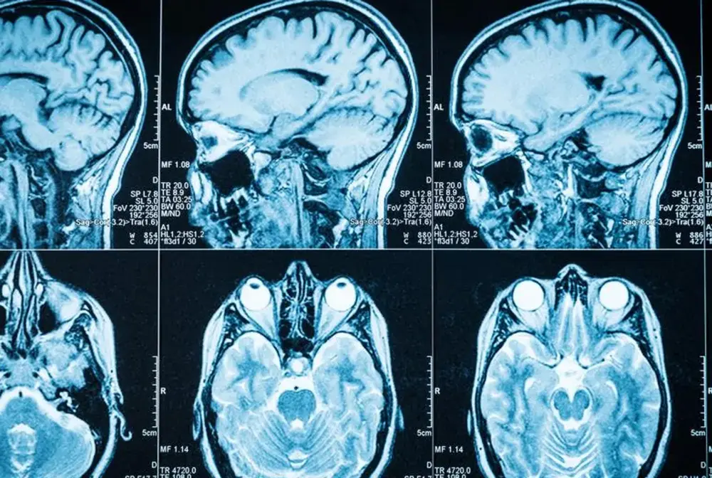 Guz mózgu - objawy, diagnostyka, leczenie. Kiedy ból głowy niepokoi?