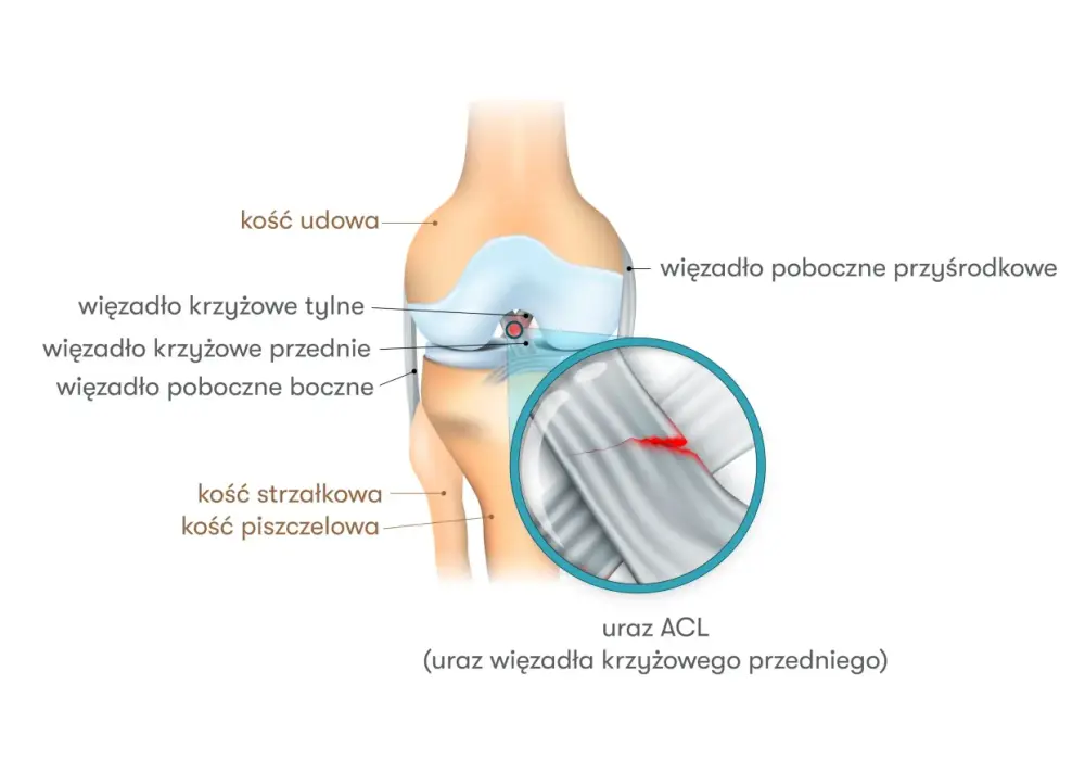Uraz ACL kolana - Jak rozpoznać, leczyć i wrócić do sportu?