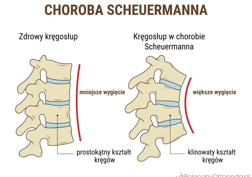 Kifoza Scheuermanna - jak ją rozpoznać i leczyć?
