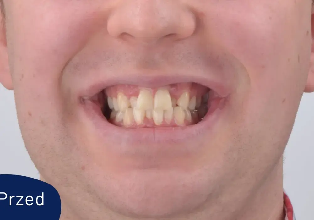 Invisalign przed i po - jak ocenić efekty leczenia?
