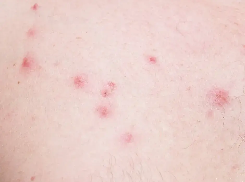 Najskuteczniejsze sposoby na pozbycie się krostek po goleniu: sprawdzone metody