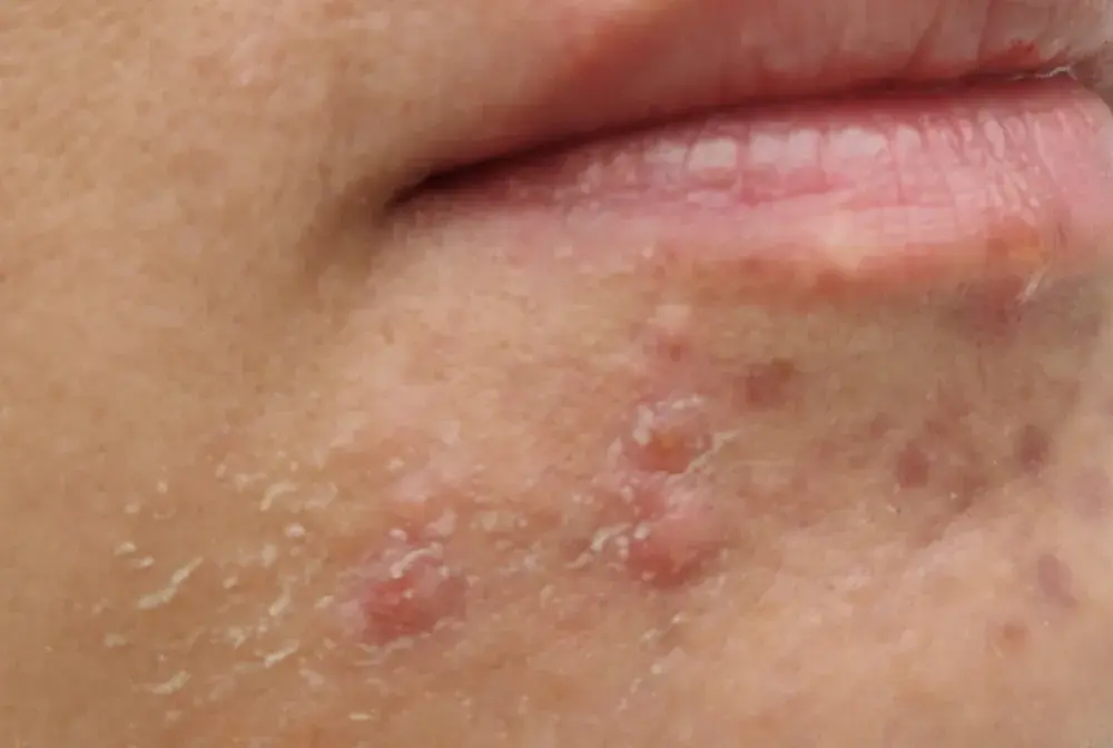 Pryszcze na brodzie - Przyczyny, pielęgnacja i kiedy do dermatologa?