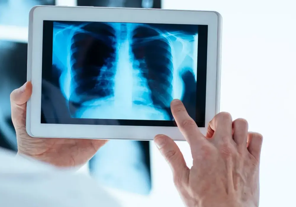 Sarkoidoza - objawy, leczenie, diagnostyka. Kiedy leczyć?