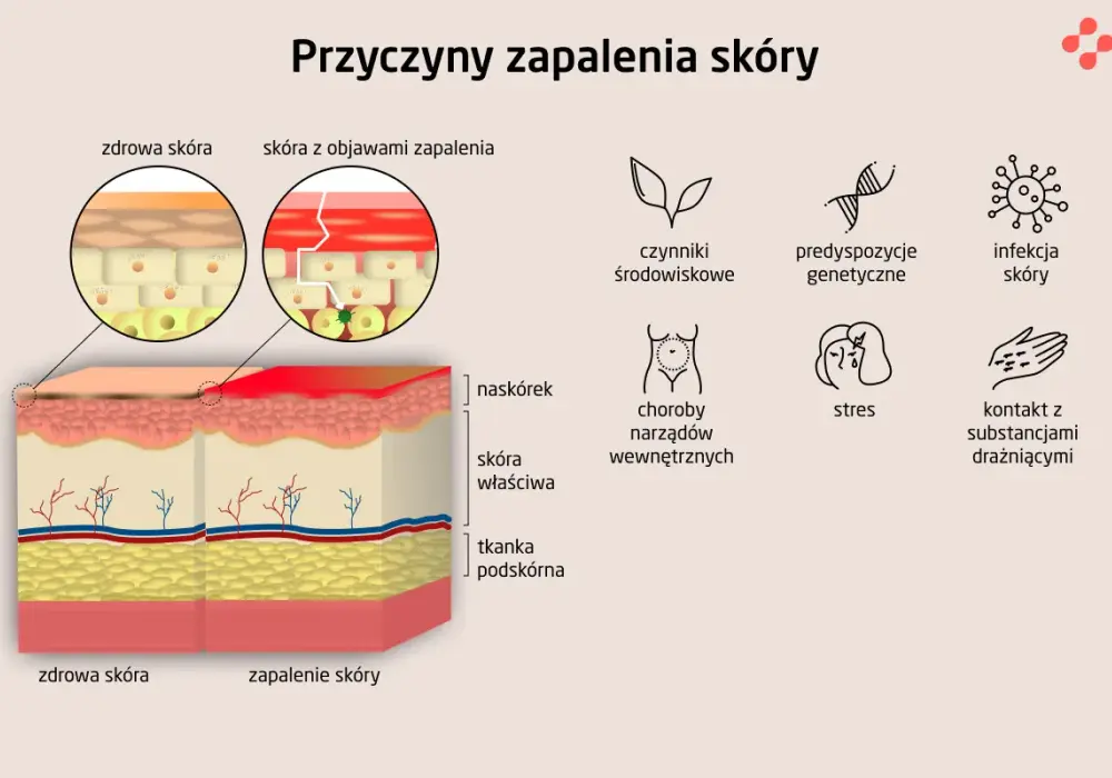 Zapalenie skóry - Jak pielęgnować i kiedy iść do lekarza?