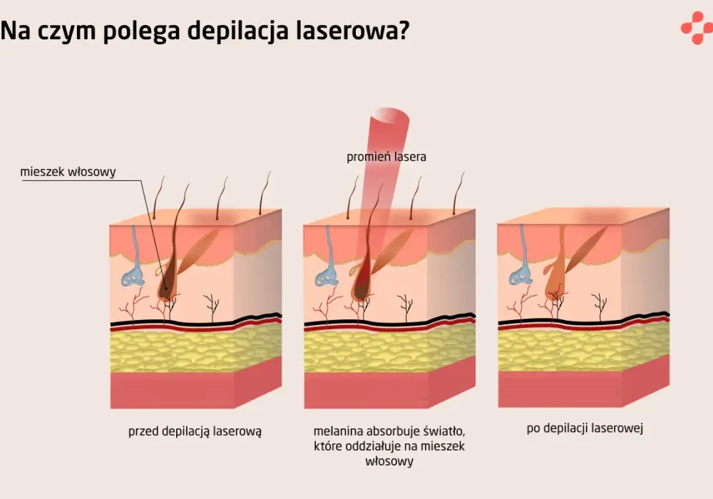 Depilacja laserowa - czy jest bezpieczna? Prawda o zabiegu