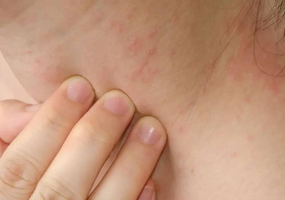 Poikilodermia - jak leczyć przebarwienia i naczynka na szyi?