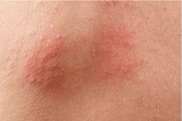 Uczulenie na perfumy: jak rozpoznać objawy i uniknąć reakcji alergicznych