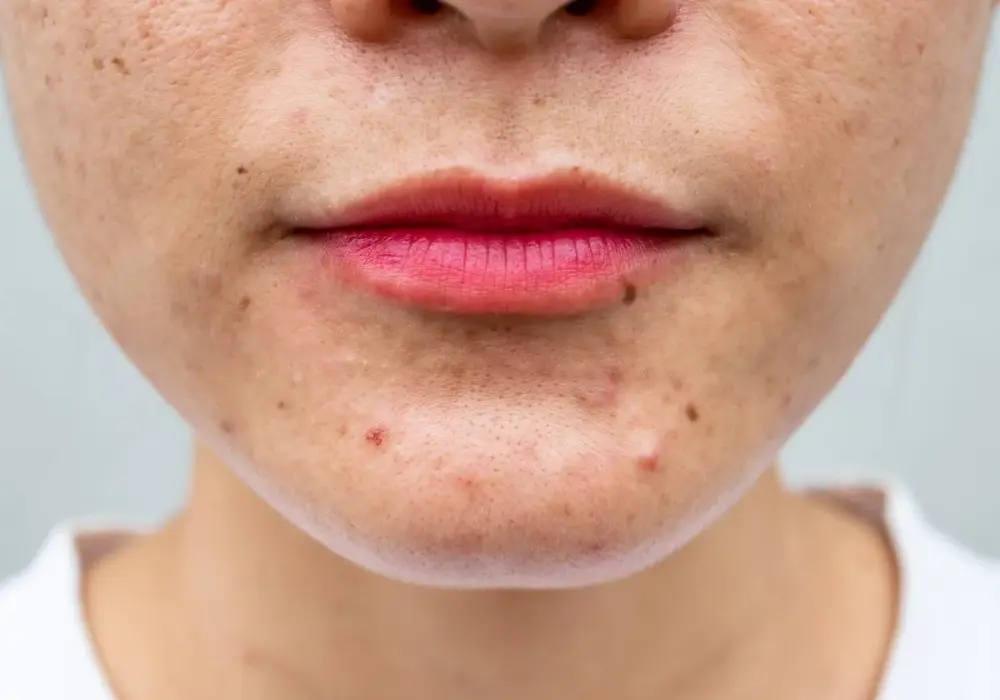 Trądzik na brodzie - co pomaga, a kiedy iść do dermatologa