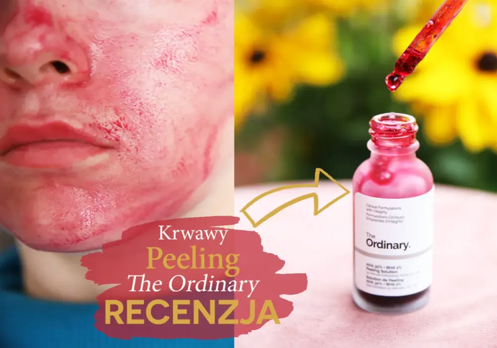 Krwawy peeling - czy warto? Działanie, bezpieczeństwo, regeneracja