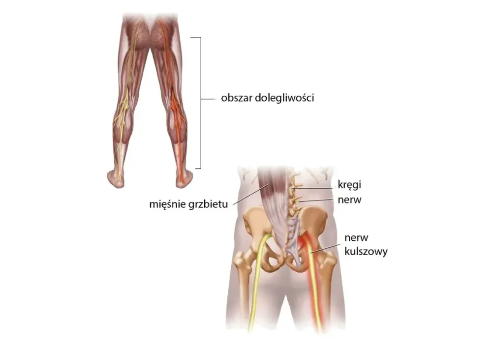 Nerw kulszowy - anatomia i ból. Dlaczego promieniuje do stopy?