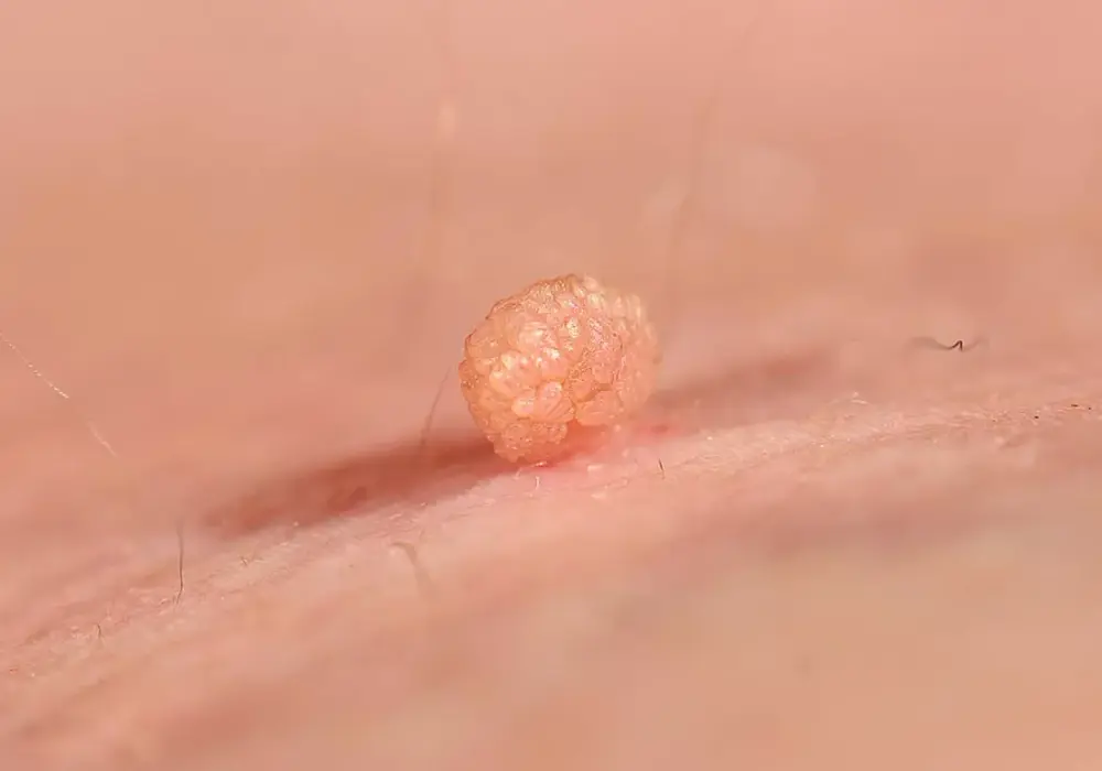 HPV u dziecka - brodawki, objawy i szczepienie